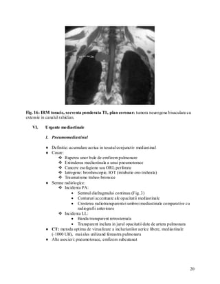 Fig. 16: IRM toracic, secventa ponderata T1, plan coronar: tumora neurogena bisaculara cu
extensie in canalul rahidian.

   VI.    Urgente mediastinale

          1. Pneumomediastinul

           Definitie: acumulare aerica in tesutul conjunctiv mediastinal
           Cauze:
                 Ruperea unor bule de emfizem pulmonare
                 Extinderea mediastinala a unui pneumotorace
                 Cancere esofagiene sau ORL perforate
                 Iatrogene: bronhoscopie, IOT (intubatie oro-traheala)
                 Traumatisme traheo-bronsice
           Semne radiologice:
                 Incidenta PA:
                         Semnul diafragmului continuu (Fig. 3)
                         Contururi accentuate ale opacitatii mediastinale
                         Cresterea radiotransparentei umbrei mediastinale comparative cu
                            radiografii anterioare
                 Incidenta LL:
                         Banda transparent retrosternala
                         Transparent inelara in jurul opacitatii date de artera pulmonara
           CT: metoda optima de vizualizare a incluziunilor aerice libere, mediastinale
            (-1000 UH), mai ales utilizand fereastra pulmonara
           Alte asocieri: pneumotorace, emfizem subcutanat




                                                                                             20
 