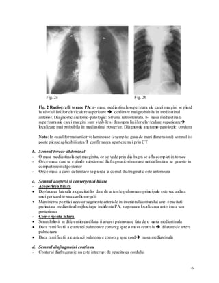 Fig. 2a                                            Fig. 2b

   Fig. 2 Radiografii torace PA: a- masa mediastinala superioara ale carei margini se pierd
   la nivelul liniilor claviculare superioare  localizare mai probabila in mediastinul
   anterior. Diagnostic anatomo-patologic: Struma retrosternala. b- masa mediastinala
   superioara ale carei margini sunt vizibile si deasupra liniilor claviculare superioare
   localizare mai probabila in mediastinul posterior. Diagnostic anatomo-patologic: cordom

   Nota: In cazul formatiunilor voluminoase (exemplu: gusa de mari dimensiuni) semnul isi
   poate pierde aplicabilitatea confirmarea apartenentei prin CT

b. Semnul toraco-abdominal
- O masa mediastinala net marginita, ce se vede prin diafragm se afla complet in torace
- Orice masa care se extinde sub domul diafragmatic si ramane net delimitate se gaseste in
   compartimentul posterior
- Orice masa a carei delimitare se pierde la domul diafragmatic este anterioara

c. Semnul acoperii si convergentei hilare
- Acoperirea hilara
 Deplasarea laterala a opacitatilor date de arterele pulmonare principale este secundara
   unei pericardite sau cardiomegalii
 Mentinerea pozitiei acestor segmente arteriale in interiorul conturului unei opacitati
   proiectata mediastinal mijlociu pe incidenta PA, sugereaza localizarea anterioara sau
   posterioara
- Conve rgenta hilara
 Semn folosit in diferentierea dilatarii arterei pulmonare fata de o masa mediastinala
 Daca ramificatii ale arterei pulmonare converg spre o masa centrala  dilatare de artera
   pulmonara
 Daca ramificatii ale arterei pulmonare converg spre cord masa mediastinala

d. Semnul diafragmului continuu
- Conturul diafragmatic nu este intrerupt de opacitatea cordului


                                                                                             6
 
