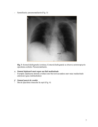 -   Semnificatie: pneumomediastin (Fig. 3)




    Fig. 3: Semnul diafragmului continuu. Conturul diafragmatic se observa neintrerupt prin
    opacitatea cordului. Pneumomediastin.

e. Semnul deplasarii unui organ sau linii mediastinale
- Exemplu: deplasarea laterala a traheei este frecvent secundara unor mase mediastinale
   anterioare (gusa multinodulara)

f. Semnul panzei de corabie
- Dat de opacitatea timusului la copii (Fig. 4)




                                                                                              7
 