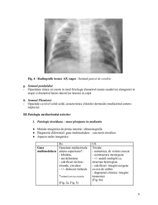 Fig. 4 : Radiografie torace AP, sugar : Semnul panzei de corabie

g. Semnul pendulului
- Opacitatea timica isi creste in mod fiziologic diametrul cranio-caudal (se alungeste) in
   inspir si diametrul latero- lateral (se lateste) in expir

h. Semnul Phemister
- Opacitate cu nivel solid-solid, caracteristica chistelor dermoide (mediastinul antero-
   mijlociu)

III. Patologia mediastinului anterior

       1. Patologie tiroidiana – mase plonjante in mediastin

        Metoda imagistica de prima intentie: ultrasonografia
        Diagnostic diferential: gusa multinodulara – carcinom tiroidian
        Aspecte radio- imagistice:

                         Rx                             US
           Gusa          Opacitate mediastinala         Tiroida:
           multinodulara antero-superioara*:            - asimetrica, de volum crescut
                         - lobulata,                    - ecostructura inomogena
                         - net delimitata               - +/- noduli multiplii cu
                         - calcificari incluse:         structura heterogena
                         rotunde, circulare             - calcificari: imagini ecogene
                         - +/- dislocare traheala       cu con de umbra
                                                        - degenerari chistice: imagini
                             *semnul cerv ico-toracic   transonice
                                                        (Fig. 6a)
                             (Fig. 2a, Fig. 5)


                                                                                             8
 