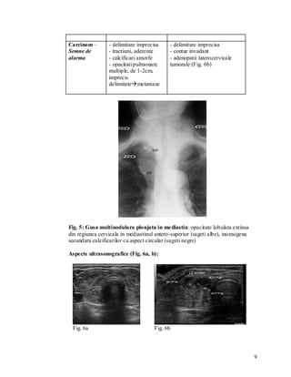 Carcinom –       - delimitare imprecisa    - delimitare imprecisa
Semne de         - tractiuni, aderente     - contur invadant
alarma           - calcificari amorfe      - adenopatii laterocervicale
                 - opacitati pulmonare     tumorale (Fig. 6b)
                 multiple, de 1-2cm,
                 imprecis
                 delimitatemetastaze




Fig. 5: Gusa multinodulara plonjata in me diastin: opacitate lobulata extinsa
din regiunea cervicala in mediastinul antero-superior (sageti albe), inomogena
secundara calcificarilor cu aspect circular (sageti negre)

Aspecte ultrasonografice (Fig. 6a, b):




 Fig. 6a                             Fig. 6b




                                                                                 9
 