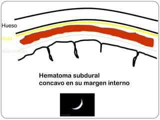 Hueso

dura

aracnoides
pia
Cerebro

             Hematoma subdural
             concavo en su margen interno
 