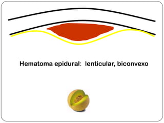 Hematoma epidural: lenticular, biconvexo
 