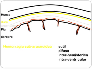 Hueso

dura
aracnoides
Pia

cerebro


 Hemorragia sub-aracnoidea   sutil
                             difusa
                             inter-hemisferica
                             intra-ventricular
 