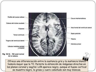 Ofrece una diferenciación entre la sustancia gris y la sustancia blanca
 todavía mayor que la TC. Permite la obtención de imágenes directas en
los planos coronal y sagital. LCR aparece negro, aunque el hueso cortical
      se muestra negro, la grasa y cuero cabelludo son muy blancas.
 