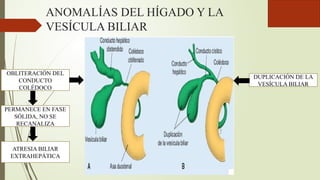 ANOMALÍAS DEL HÍGADO Y LA
VESÍCULA BILIAR
DUPLICACIÓN DE LA
VESÍCULA BILIAR
OBLITERACIÓN DEL
CONDUCTO
COLÉDOCO
PERMANECE EN FASE
SÓLIDA, NO SE
RECANALIZA
ATRESIA BILIAR
EXTRAHEPÁTICA
 