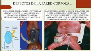 DEFECTOS DE LA PARED CORPORAL
ONFALOCELE: HERNIACIÓN DE LAS VISCERAS
ABDOMINALES POR UN ANILLO UMBILICAL
AGRANDADO. SE PRODUCE POR UNA
INCAPACIDAD DE REGRESAR A LA CAVIDAD
ABDOMINAL
GASTROSQUISIS: CIERRE ANORMAL DE LA PARED DEL
CUERPO ALREDEDOR DEL PEDÍCULO DE FIJACIÓN.
VISCERAS NO ESTAN CUBIERTAS POR EL PERITONEO
O EL AMNIOS, POR LO QUE EL INTESTINO PUEDE
DAÑARSE POR EXPOSICIÓN AL LÍQUIDO AMNIÓTICO
 