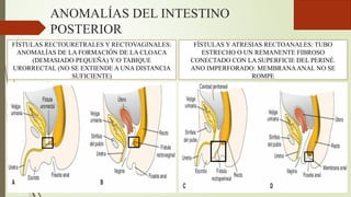 ANOMALÍAS DEL INTESTINO
POSTERIOR
FÍSTULAS RECTOURETRALES Y RECTOVAGINALES:
ANOMALÍAS DE LA FORMACIÓN DE LA CLOACA
(DEMASIADO PEQUEÑA) Y/O TABIQUE
URORRECTAL (NO SE EXTIENDE A UNA DISTANCIA
SUFICIENTE)
FÍSTULAS Y ATRESIAS RECTOANALES: TUBO
ESTRECHO O UN REMANENTE FIBROSO
CONECTADO CON LA SUPERFICIE DEL PERINÉ.
ANO IMPERFORADO: MEMBRANAANAL NO SE
ROMPE
 
