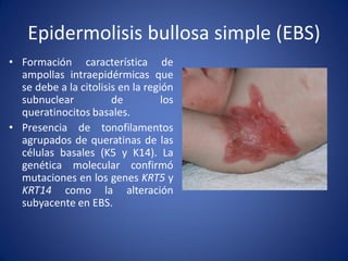 Epidermolisis bullosa simple (EBS)
• Formación característica de
ampollas intraepidérmicas que
se debe a la citolisis en la región
subnuclear
de
los
queratinocitos basales.
• Presencia de tonofilamentos
agrupados de queratinas de las
células basales (K5 y K14). La
genética molecular confirmó
mutaciones en los genes KRT5 y
KRT14 como la alteración
subyacente en EBS.

 