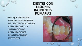 DIENTES CON 
LESIONES 
INCIPIENTES 
PRIMARIAS 
• HAY QUE DISTINGUIR 
ENTRE EL TRATAMIENTO 
DE DIENTES CARIADOS NO 
RESTAURADOS Y LA 
SUSTITUCIÓN DE 
RESTAURACIONES 
INSATISFACTORIAS 
EXISTENTES. 
 
