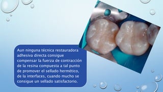 Aun ninguna técnica restauradora 
adhesiva directa consigue 
compensar la fuerza de contracción 
de la resina compuesta a tal punto 
de promover el sellado hermético, 
de la interfaces, cuando mucho se 
consigue un sellado satisfactorio. 
 