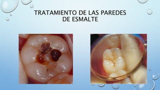 TRATAMIENTO DE LAS PAREDES 
DE ESMALTE 
 