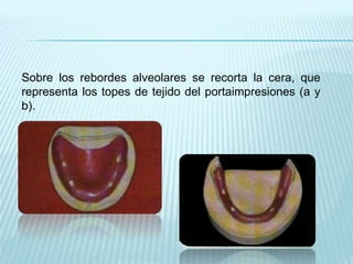 Sobre los rebordes alveolares se recorta la cera, que
representa los topes de tejido del portaimpresiones (a y
b).
 