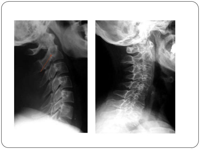 Duele el cuello no puedo girar la cabeza