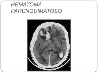 HEMATOMA
PARENQUIMATOSO
 