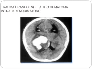 TRAUMA CRANEOENCEFALICO HEMATOMA
INTRAPARENQUIMATOSO
 