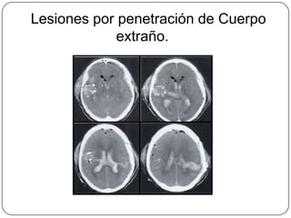 Lesiones por penetración de Cuerpo
             extraño.
 