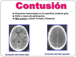 • Pequeñas hemorragias en la superficie (materia gris).
        • Daño a vasos de parénquima.
        • Mas común: Lóbulo Frontal y Temporal




Contusión del mismo lado              Contusión del lado opuesto
 