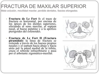 Traumatismo facial | PPTX