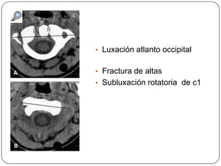 • Luxación atlanto occipital


• Fractura de altas
• Subluxación rotatoria de c1
 