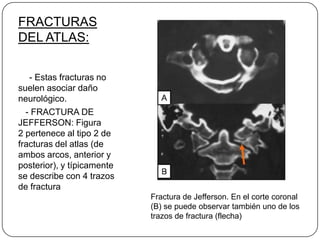 FRACTURAS
DEL ATLAS:

   - Estas fracturas no
suelen asociar daño
neurológico.
  - FRACTURA DE
JEFFERSON: Figura
2 pertenece al tipo 2 de
fracturas del atlas (de
ambos arcos, anterior y
posterior), y típicamente
se describe con 4 trazos
de fractura
                            Fractura de Jefferson. En el corte coronal
                            (B) se puede observar también uno de los
                            trazos de fractura (flecha)
 