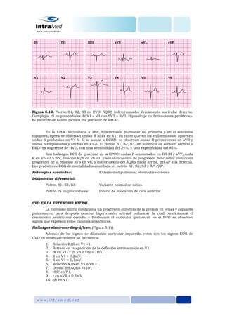 Figura 5.10. Patrón S1, S2, S3 de CVD. ÂQRS indeterminado. Crecimiento auricular derecho.
Complejos rS en precordiales de V1 a V3 con SV3 > SV2. Hipovoltaje en derivaciones periféricas.
El paciente de hábito pícnico era portador de EPOC.
En la EPOC secundaria a TEP, hipertensión pulmonar no primaria y en el síndrome
hipopnea/apnea se observan ondas R altas en V1; en tanto que en los enfisematosos aparecen
ondas S profundas en V4-6. Si se asocia a BCRD, se observan ondas R prominentes en aVR y
ondas S empastadas y anchas en V5-6. El patrón S1, S2, S3 –en ausencia de corazón vertical o
BRD- es sugerente de HVD, con una sensibilidad del 24%, y una especificidad del 87%.
Son hallazgos ECG de gravedad de la EPOC: ondas P acuminadas en DII-III y aVF, onda
R en V6 <0,5 mV, relación R/S en V6 <1; y son indicadores de progresión del cuadro: reducción
progresiva de la relación R/S en V6, y mayor desvío del ÂQRS hacia arriba, del ÂP a la derecha.
Los predictores ECG de mortalidad aumentada: el patrón S1, S2, S3 y ÂP >90°.
Patologías asociadas: Enfermedad pulmonar obstructiva crónica
Diagnóstico diferencial:
Patrón S1, S2, S3: Variante normal en niños.
Patrón rS en precordiales: Infarto de miocardio de cara anterior.
CVD EN LA ESTENOSIS MITRAL
La estenosis mitral condiciona un progresivo aumento de la presión en venas y capilares
pulmonares, para después generar hipertensión arterial pulmonar la cual condicionará el
crecimiento ventricular derecho y finalmente el auricular ipsilateral; en el ECG se observan
signos que expresan estos cambios anatómicos.
Hallazgos electrocardiográficos: (Figura 5.11)
Además de los signos de dilatación auricular izquierda, estos son los signos ECG de
CVD en orden decreciente de frecuencia:
1. Relación R/S en V1 >1.
2. Retraso en la aparición de la deflexión intrinsecoide en V1.
3. (R en V1) + (S V5 ó V6) > 1mV.
4. S en V1 < 0,2mV.
5. R en V1 > 0,7mV.
6. Relación R/S en V5 ó V6 <1.
7. Desvío del AQRS >110°.
8. rSR’ en V1.
9. r en aVR < 0,5mV.
10. qR en V1.
 