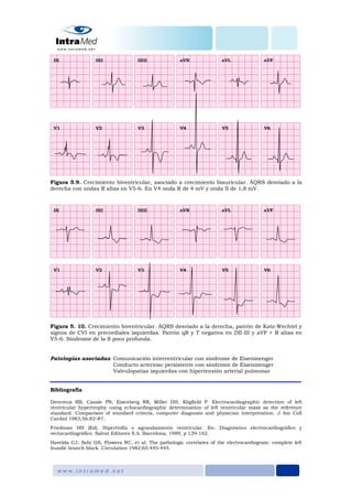 Figura 5.9. Crecimiento biventricular, asociado a crecimiento biauricular. ÂQRS desviado a la
derecha con ondas R altas en V5-6. En V4 onda R de 4 mV y onda S de 1,8 mV.
Figura 5. 10. Crecimiento biventricular. ÂQRS desviado a la derecha, patrón de Katz-Wechtel y
signos de CVI en precordiales izquierdas. Patrón qR y T negativa en DII-III y aVF + R altas en
V5-6. Síndrome de la S poco profunda.
Patologías asociadas Comunicación interventricular con síndrome de Eisenmenger
Conducto arterioso persistente con síndrome de Eisenmenger
Valvulopatías izquierdas con hipertensión arterial pulmonar
Bibliografía
Devereux RB, Casale PN, Eisenberg RR, Miller DH, Kligfield P. Electrocardiographic detection of left
ventricular hypertrophy using echocardiographic determination of left ventricular mass as the reference
standard. Comparison of standard criteria, computer diagnosis and physician interpretation. J Am Coll
Cardiol 1983;56:82–87.
Friedman HH (Ed). Hipertrofia o agrandamiento ventricular. En: Diagnóstico electrocardiográfico y
vectocardiográfico. Salvat Editores S.A. Barcelona, 1989, p 129-162.
Havelda CJ, Sohi GS, Flowers NC, et al. The pathologic correlates of the electrocardiogram: complete left
bundle branch block. Circulation 1982;65:445-445.
 