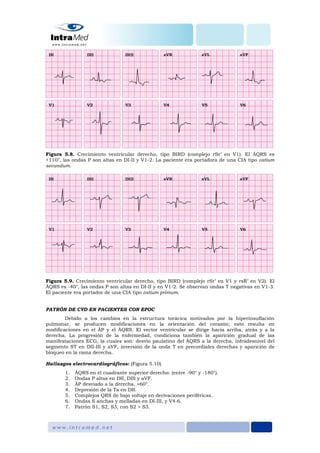 Figura 5.8. Crecimiento ventricular derecho, tipo BIRD (complejo rSr’ en V1). El ÂQRS es
+110°, las ondas P son altas en DI-II y V1-2. La paciente era portadora de una CIA tipo ostium
secundum.
Figura 5.9. Crecimiento ventricular derecho, tipo BIRD (complejo rSr’ en V1 y rsR’ en V2). El
ÂQRS es -40°, las ondas P son altas en DI-II y en V1-2. Se observan ondas T negativas en V1-3.
El paciente era portador de una CIA tipo ostium primum.
PATRÓN DE CVD EN PACIENTES CON EPOC
Debido a los cambios en la estructura torácica motivados por la hiperinsuflación
pulmonar, se producen modificaciones en la orientación del corazón; esto resulta en
modificaciones en el ÂP y el ÂQRS. El vector ventricular se dirige hacia arriba, atrás y a la
derecha. La progresión de la enfermedad, condiciona también la aparición gradual de las
manifestaciones ECG, la cuales son: desvío paulatino del ÂQRS a la derecha, infradesnivel del
segmento ST en DII-III y aVF, inversión de la onda T en precordiales derechas y aparición de
bloqueo en la rama derecha.
Hallazgos electrocardiográficos: (Figura 5.10)
1. ÂQRS en el cuadrante superior derecho: (entre -90° y -180°).
2. Ondas P altas en DII, DIII y aVF.
3. ÂP desviado a la derecha, >60°.
4. Depresión de la Ta en DII.
5. Complejos QRS de bajo voltaje en derivaciones periféricas.
6. Ondas S anchas y melladas en DI-III, y V4-6.
7. Patrón S1, S2, S3, con S2 > S3.
 