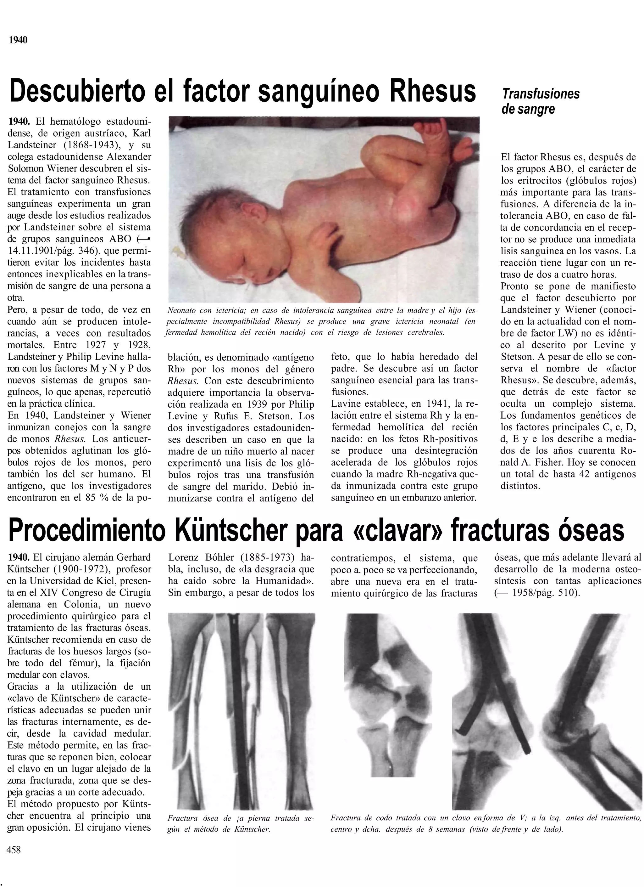 1940




    Descubierto el factor sanguíneo Rhesus                                                                                           Transfusiones
                                                                                                                                     de sangre
    1940. El hematólogo estadouni-
    dense, de origen austríaco, Karl
    Landsteiner (1868-1943), y su
    colega estadounidense Alexander                                                                                                  El factor Rhesus es, después de
    Solomon Wiener descubren el sis-                                                                                                 los grupos ABO, el carácter de
    tema del factor sanguíneo Rhesus.                                                                                                los eritrocitos (glóbulos rojos)
    El tratamiento con transfusiones                                                                                                 más importante para las trans-
    sanguíneas experimenta un gran                                                                                                   fusiones. A diferencia de la in-
    auge desde los estudios realizados                                                                                               tolerancia ABO, en caso de fal-
    por Landsteiner sobre el sistema                                                                                                 ta de concordancia en el recep-
    de grupos sanguíneos ABO (—•                                                                                                     tor no se produce una inmediata
    14.11.1901/pág. 346), que permi-                                                                                                 lisis sanguínea en los vasos. La
    tieron evitar los incidentes hasta                                                                                               reacción tiene lugar con un re-
    entonces inexplicables en la trans-                                                                                              traso de dos a cuatro horas.
    misión de sangre de una persona a                                                                                                Pronto se pone de manifiesto
    otra.                                                                                                                            que el factor descubierto por
    Pero, a pesar de todo, de vez en       Neonato con ictericia; en caso de intolerancia sanguínea entre la madre y el hijo (es-    Landsteiner y Wiener (conoci-
    cuando aún se producen intole-        pecialmente incompatibilidad Rhesus) se produce una grave ictericia neonatal (en-          do en la actualidad con el nom-
    rancias, a veces con resultados       fermedad hemolítica del recién nacido) con el riesgo de lesiones cerebrales.               bre de factor LW) no es idénti-
    mortales. Entre 1927 y 1928,                                                                                                     co al descrito por Levine y
    Landsteiner y Philip Levine halla-    blación, es denominado «antígeno              feto, que lo había heredado del              Stetson. A pesar de ello se con-
    ron con los factores M y N y P dos    Rh» por los monos del género                  padre. Se descubre así un factor             serva el nombre de «factor
    nuevos sistemas de grupos san-        Rhesus. Con este descubrimiento               sanguíneo esencial para las trans-           Rhesus». Se descubre, además,
    guíneos, lo que apenas, repercutió    adquiere importancia la observa-              fusiones.                                    que detrás de este factor se
    en la práctica clínica.               ción realizada en 1939 por Philip             Lavine establece, en 1941, la re-            oculta un complejo sistema.
    En 1940, Landsteiner y Wiener         Levine y Rufus E. Stetson. Los                lación entre el sistema Rh y la en-          Los fundamentos genéticos de
    inmunizan conejos con la sangre       dos investigadores estadouniden-              fermedad hemolítica del recién               los factores principales C, c, D,
    de monos Rhesus. Los anticuer-        ses describen un caso en que la               nacido: en los fetos Rh-positivos            d, E y e los describe a media-
    pos obtenidos aglutinan los gló-      madre de un niño muerto al nacer              se produce una desintegración                dos de los años cuarenta Ro-
    bulos rojos de los monos, pero        experimentó una lisis de los gló-             acelerada de los glóbulos rojos              nald A. Fisher. Hoy se conocen
    también los del ser humano. El        bulos rojos tras una transfusión              cuando la madre Rh-negativa que-             un total de hasta 42 antígenos
    antígeno, que los investigadores      de sangre del marido. Debió in-               da inmunizada contra este grupo              distintos.
    encontraron en el 85 % de la po-      munizarse contra el antígeno del              sanguíneo en un embarazo anterior.


    Procedimiento Küntscher para «clavar» fracturas óseas
    1940. El cirujano alemán Gerhard      Lorenz Bóhler (1885-1973) ha-                contratiempos, el sistema, que               óseas, que más adelante llevará al
    Küntscher (1900-1972), profesor       bla, incluso, de «la desgracia que           poco a. poco se va perfeccionando,           desarrollo de la moderna osteo-
    en la Universidad de Kiel, presen-    ha caído sobre la Humanidad».                abre una nueva era en el trata-              síntesis con tantas aplicaciones
    ta en el XIV Congreso de Cirugía      Sin embargo, a pesar de todos los            miento quirúrgico de las fracturas           (— 1958/pág. 510).
    alemana en Colonia, un nuevo
    procedimiento quirúrgico para el
    tratamiento de las fracturas óseas.
    Küntscher recomienda en caso de
    fracturas de los huesos largos (so-
    bre todo del fémur), la fijación
    medular con clavos.
    Gracias a la utilización de un
    «clavo de Küntscher» de caracte-
    rísticas adecuadas se pueden unir
    las fracturas internamente, es de-
    cir, desde la cavidad medular.
    Este método permite, en las frac-
    turas que se reponen bien, colocar
    el clavo en un lugar alejado de la
    zona fracturada, zona que se des-
    peja gracias a un corte adecuado.
    El método propuesto por Künts-
    cher encuentra al principio una       Fractura ósea de ¡a pierna tratada se-       Fractura de codo tratada con un clavo en forma de V; a la izq. antes del tratamiento,
    gran oposición. El cirujano vienes    gún el método de Küntscher.                  centro y dcha. después de 8 semanas (visto de frente y de lado).

    458


.
 