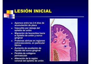 LESIÓN INICIAL
LESI
LESIÓ
ÓN INICIAL
N INICIAL
„ Aparece entre los 2-4 días de
acumulación de placa
„ Vasculitis por debajo del
epitelio de unión
„ Migración de leucocitos hacia
el epitelio de unión y surco
gingival
„ Proteinas séricas en regiones
extravasculares, en particular
fibrina
„ Aumento de exudación de
líquido del surco gingival
„ Pérdida de colágeno
perivascular
„ Alteración de la región
coronal del epitelio de unión
„ Aparece entre los 2-4 días de
acumulación de placa
„ Vasculitis por debajo del
epitelio de unión
„ Migración de leucocitos hacia
el epitelio de unión y surco
gingival
„ Proteinas séricas en regiones
extravasculares, en particular
fibrina
„ Aumento de exudación de
líquido del surco gingival
„ Pérdida de colágeno
perivascular
„ Alteración de la región
coronal del epitelio de unión
 
