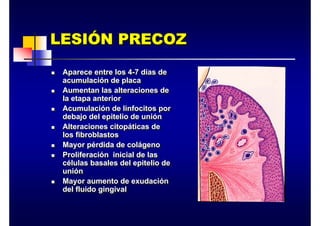 LESIÓN PRECOZ
LESI
LESIÓ
ÓN PRECOZ
N PRECOZ
„ Aparece entre los 4-7 días de
acumulación de placa
„ Aumentan las alteraciones de
la etapa anterior
„ Acumulación de linfocitos por
debajo del epitelio de unión
„ Alteraciones citopáticas de
los fibroblastos
„ Mayor pérdida de colágeno
„ Proliferación inicial de las
células basales del epitelio de
unión
„ Mayor aumento de exudación
del fluido gingival
„ Aparece entre los 4-7 días de
acumulación de placa
„ Aumentan las alteraciones de
la etapa anterior
„ Acumulación de linfocitos por
debajo del epitelio de unión
„ Alteraciones citopáticas de
los fibroblastos
„ Mayor pérdida de colágeno
„ Proliferación inicial de las
células basales del epitelio de
unión
„ Mayor aumento de exudación
del fluido gingival
 