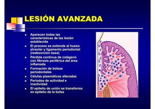 LESIÓN AVANZADA
LESI
LESIÓ
ÓN AVANZADA
N AVANZADA
„ Aparecen todas las
características de las lesión
establecida
„ El proceso se extiende al hueso
alveolar y ligamento periodontal
(reabsorción ósea)
„ Pérdida continua de colágeno
con fibrosis periférica del área
inflamada
„ Formación de bolsas
periodontales
„ Células plasmáticas alteradas
„ Periodos de actividad e
inactividad
„ El epitelio de unión se transforma
en epitelio de la bolsa
„ Aparecen todas las
características de las lesión
establecida
„ El proceso se extiende al hueso
alveolar y ligamento periodontal
(reabsorción ósea)
„ Pérdida continua de colágeno
con fibrosis periférica del área
inflamada
„ Formación de bolsas
periodontales
„ Células plasmáticas alteradas
„ Periodos de actividad e
inactividad
„ El epitelio de unión se transforma
en epitelio de la bolsa
 