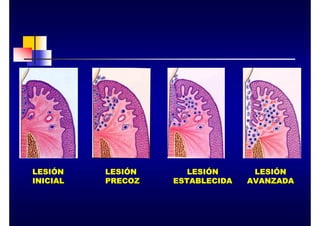 LESI
LESIÓ
ÓN
N
INICIAL
INICIAL
LESI
LESIÓ
ÓN
N
PRECOZ
PRECOZ
LESI
LESIÓ
ÓN
N
ESTABLECIDA
ESTABLECIDA
LESI
LESIÓ
ÓN
N
AVANZADA
AVANZADA
 
