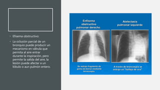 • Efisema obstructivo:
• La oclusión parcial de un
bronquio puede producir un
mecanismo en válvula que
permita al aire ent...
