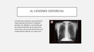 A) LESIONES ESPÚRICAS
• Las lesiones espúreas que producen
hiperclaridad pulmonar unilateral
pueden ser debidas a la pérdi...