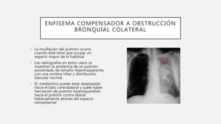 ENFISEMA COMPENSADOR A OBSTRUCCIÓN
BRONQUIAL COLATERAL
• La insuflación del pulmón ocurre
cuando éste tiene que ocupar un
...