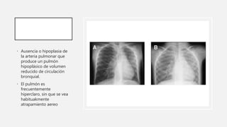 • Ausencia o hipoplasia de
la arteria pulmonar que
produce un pulmón
hipoplásico de volumen
reducido de circulación
bronqu...