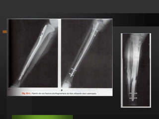 Fracturas de la piernaCapitulo 63