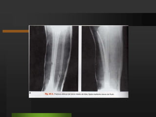 FRACTURAS DE LA PIERNALa naturaleza del mecanismo fracturario permite su clasificación en lesiones por baja y alta energía: