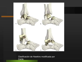 Clavo intramedular de Küntscher. (más utilizado)