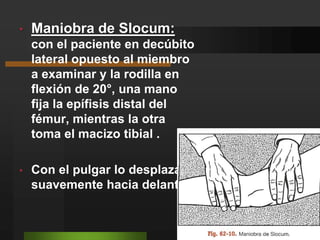 la rodilla en flexión de 20°, mientras una mano fija el extremo distal del fémur, la otra toma el proximal de la tibia, apoyando el pulgar sobre el reborde e intentando desplazarlo hacia a delante.Si esto se logra , señala lesión.