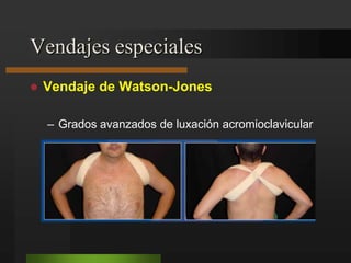 Tipos de inmovilizaciónCapítulo 66