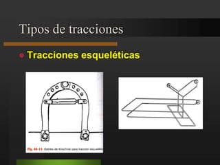 Cuidados de la confección del yeso