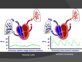 ARTERIA PULMONAR PRESIÓN CUÑA 