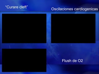 “ Curare cleft” Oscilaciones cardiogenicas Flush de O2 