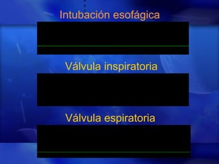 Intubación esofágica
a
g
u
s
  
 
 
 
 
 
 
 
 
 
 
 
 
 
 
 
 
 
 
 
 
 
 
 
 
 
  
 
 
 
 
 
 
 
 
 
 
 
 
 
 
 
 
 
 
 
 
 
 
 
 
 
Válvula inspiratoria
Válvula espiratoria
 