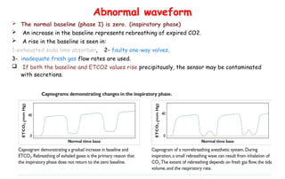 Capnogram and Spirometry principles and its uses in Operation theatres ...