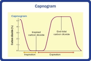 Capnogram
 