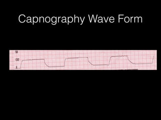 Capnography Wave Form
 