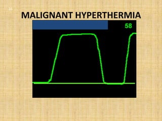 16

     MALIGNANT HYPERTHERMIA
 